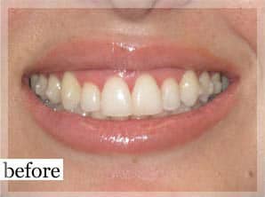 Before Image: Smile Makeover - front