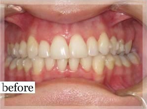 Before Image: Smile Makeover - front