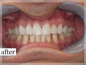 After Image: Smile Makeover - front