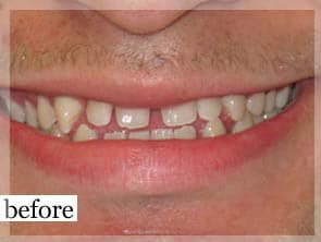 Before Image: Smile Makeover - front