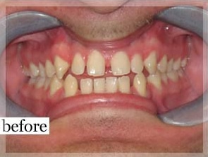 Before Image: Smile Makeover - front