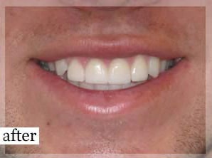 After Image: Smile Makeover - front