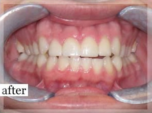 After Image: Smile Makeover - front