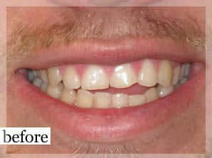 Before Image: Smile Makeover - front