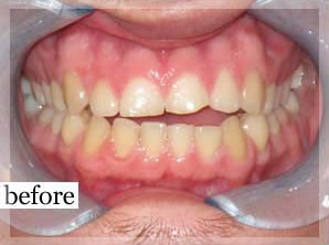 Before Image: Smile Makeover - front