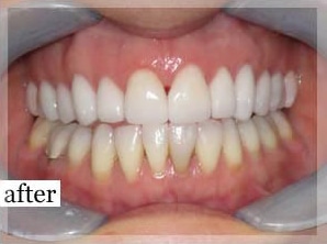 After Image: Smile Makeover - front