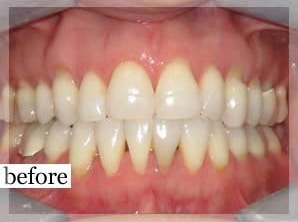 Before Image: Smile Makeover - front