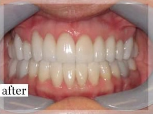 After Image: Smile Makeover - front