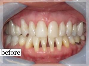 Before Image: Smile Makeover - front