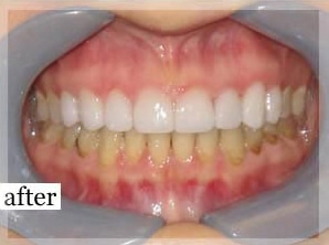 After Image: Smile Makeover - front