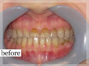 Before Image: Smile Makeover - front