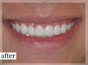 After Image: Smile Makeover - front