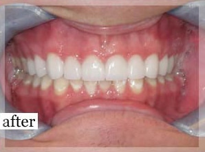 After Image: Smile Makeover - front