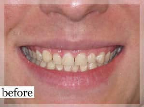 Before Image: Smile Makeover - front