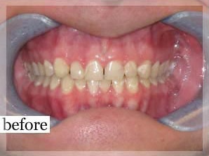 Before Image: Smile Makeover - front