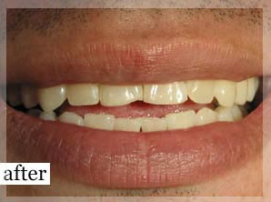 After Image: Smile Makeover - front