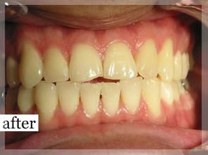 After Image: Smile Makeover - front