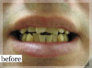 Before Image: Smile Makeover - front