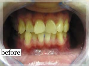 Before Image: Smile Makeover - front