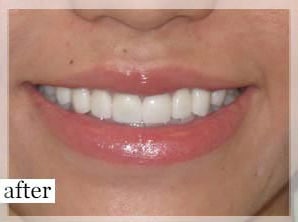 After Image: Smile Makeover - front