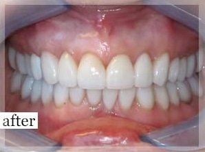 After Image: Smile Makeover - front