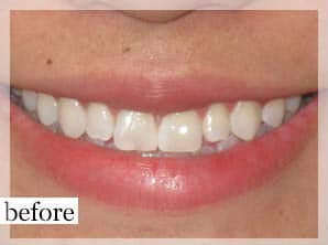 Before Image: Smile Makeover - front