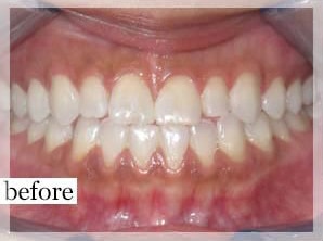 Before Image: Smile Makeover - front