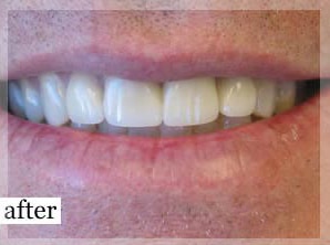 After Image: Smile Makeover - front