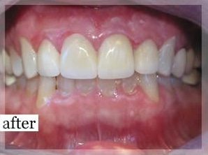 After Image: Smile Makeover - front