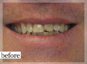 Before Image: Smile Makeover - front