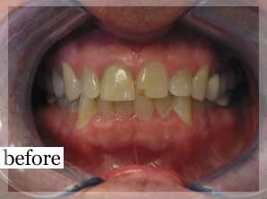 Before Image: Smile Makeover - front