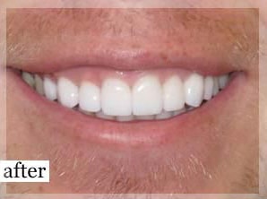 After Image: Smile Makeover - front