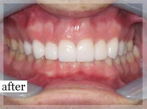 After Image: Smile Makeover - front