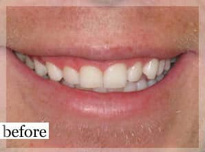 Before Image: Smile Makeover - front