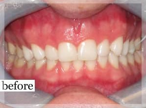 Before Image: Smile Makeover - front