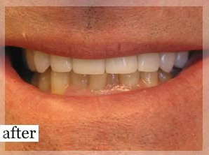 After Image: Smile Makeover - front