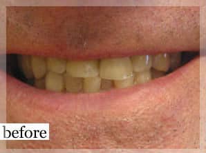 Before Image: Smile Makeover - front