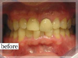 Before Image: Smile Makeover - front