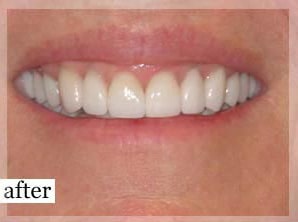 After Image: Smile Makeover - front