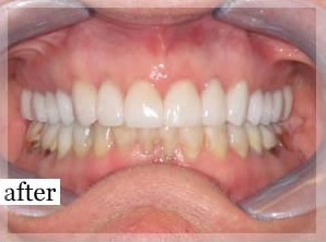 After Image: Smile Makeover - front