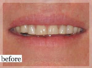 Before Image: Smile Makeover - front