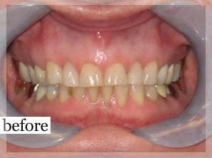 Before Image: Smile Makeover - front