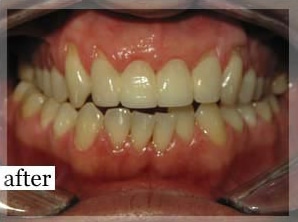 After Image: Smile Makeover - front