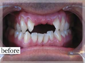 Before Image: Smile Makeover - front