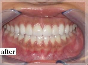 After Image: Smile Makeover - front