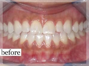 Before Image: Smile Makeover - front