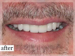 After Image: Smile Makeover - front