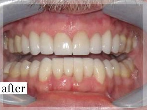 After Image: Smile Makeover - front