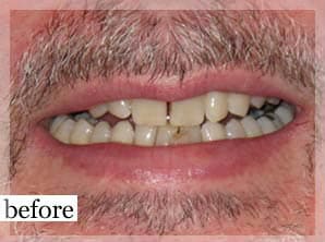 Before Image: Smile Makeover - front