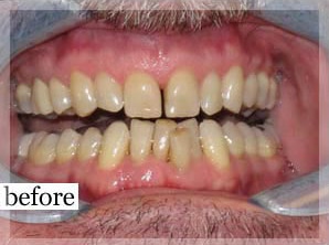 Before Image: Smile Makeover - front